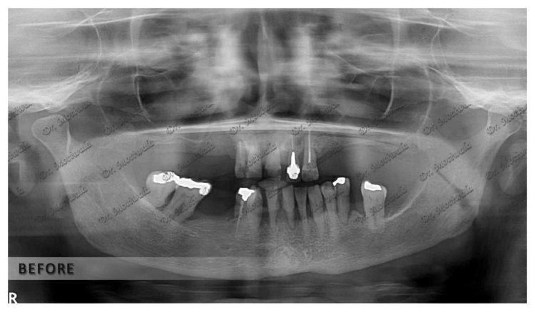 Basal Implants In Hyderabad Dr Motiwala Dental Implants Center