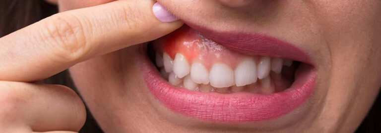 Treatment Of Infected Gums Dr Motiwala Dental Clinic Implant Centre