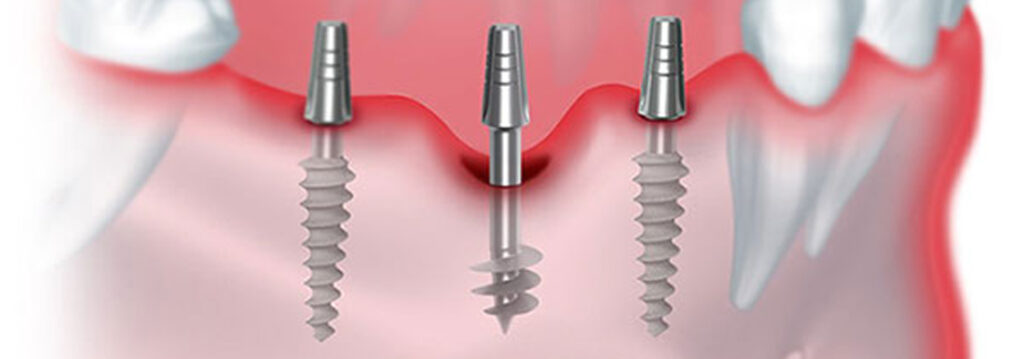 Prognosis Of A Polished Surface Basal Implant Dr Motiwala Dental