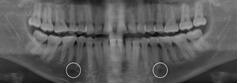 Radiographic Identification Of Unilateral Accessory Mental Foramen Dr