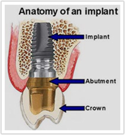 What is dental implant?