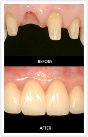 What is dental implant?