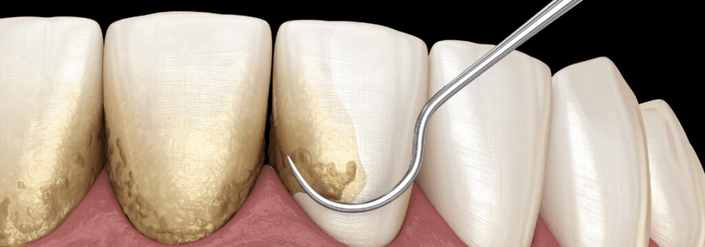 best thing to get rid of plaque on teeth