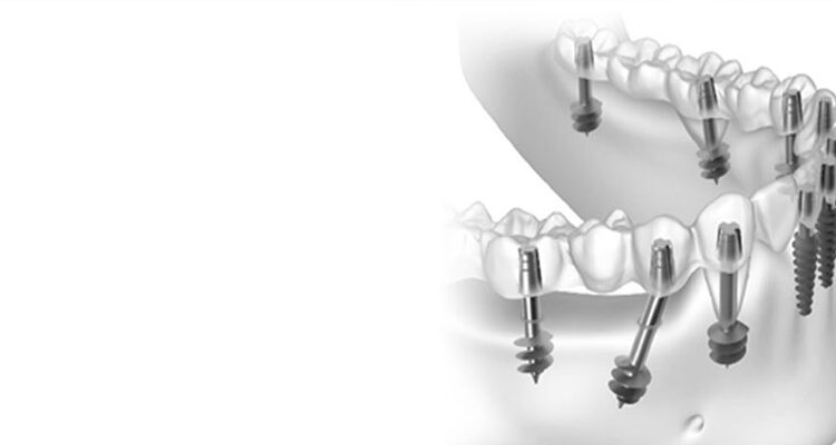 Basal Implants: A Minimally Invasive Alternative to Bone Grafts