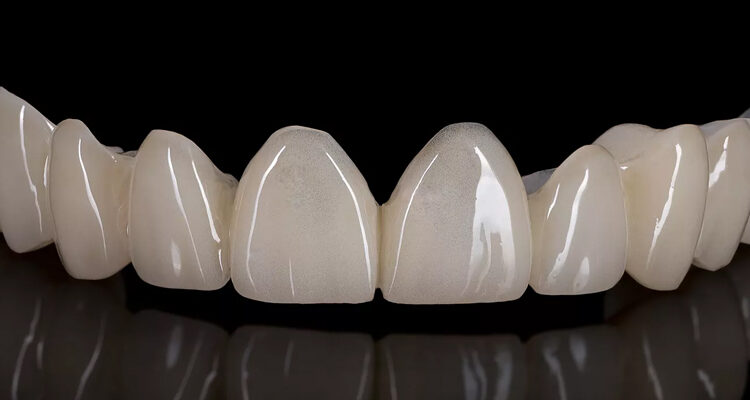 Transforming Smiles with Basal Implants & Zirconia Crowns