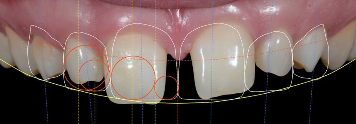 The Perfect Fusion: Digital Smile Design Meets Artistic Dentistry