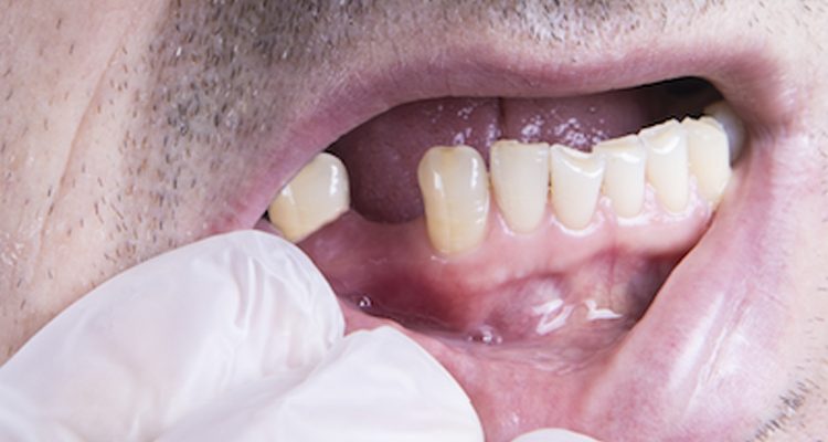 Basal Implants - The Future for Gum Disease or Bone Loss Patients