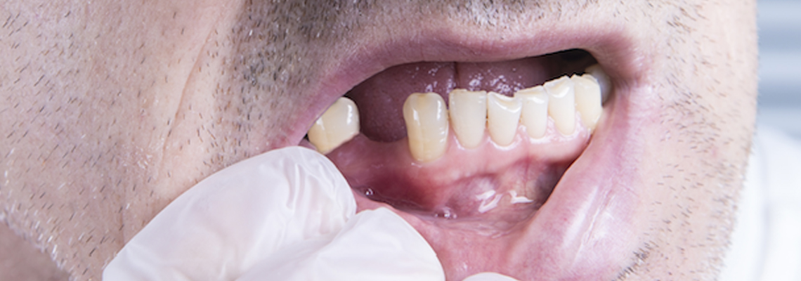 Basal Implants - The Future for Gum Disease or Bone Loss Patients